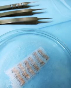 Haar Transplantation Türkei: Grafts