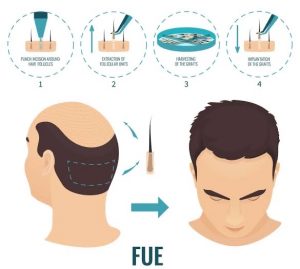 Fue Haartransplantation Türkei
